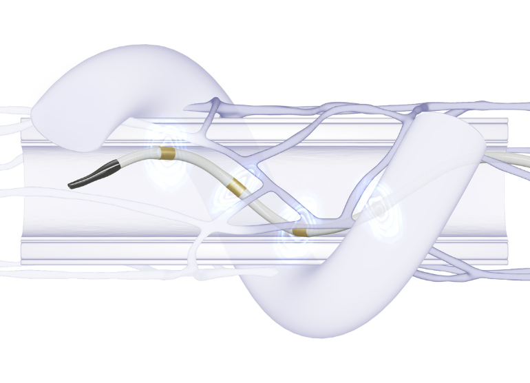 rdn system ablation