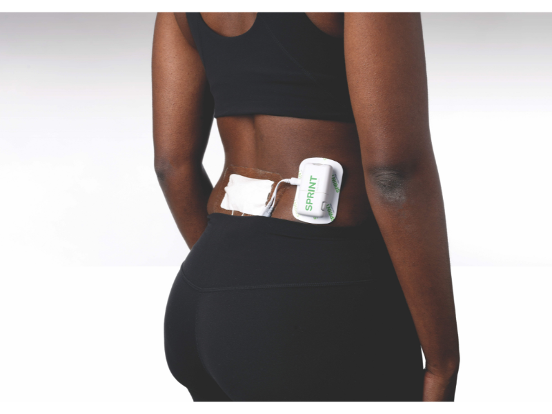 Sprint PNS on Lower Back