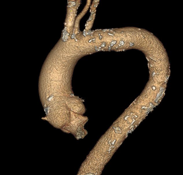 Aorta CT Scan