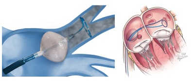 Catheter ablation