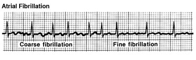 afib