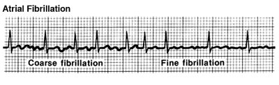 afib