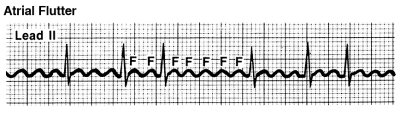 atrial flutter