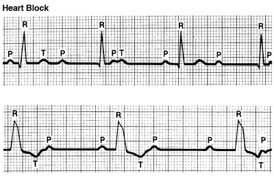 Heart block