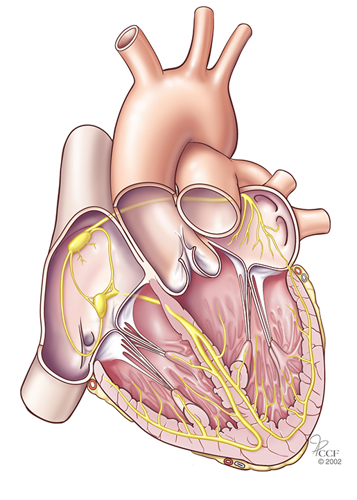 Accessory pathway