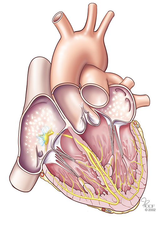 Atrial fibrillation