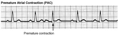 Premature atrial contractions