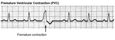 Premature ventricular contractions