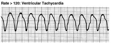 Ventricular tachycardia
