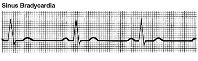 Sinus bradycardia