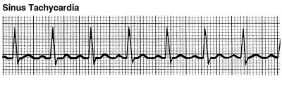 sinus tach