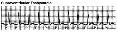 Supraventricular tachycardia