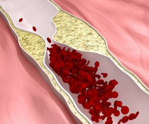 Graphic of calcified artery