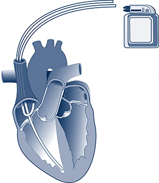 dual chamber pacemaker