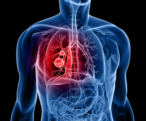 lung cancer