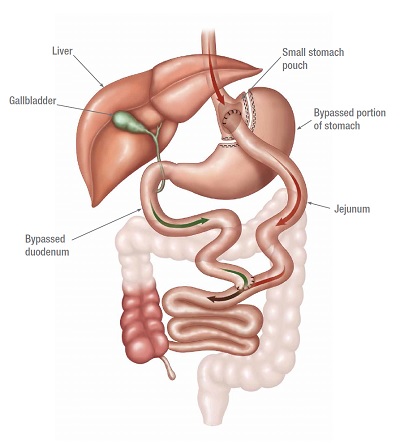 Gastric bypass