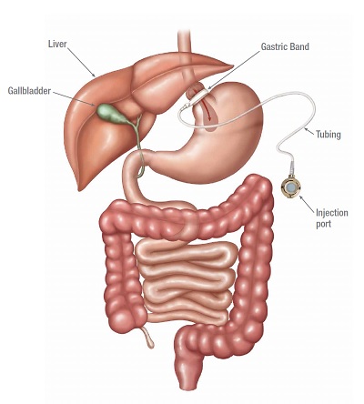 Adjustable gastric banding