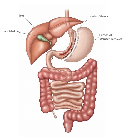 Gastric sleeve