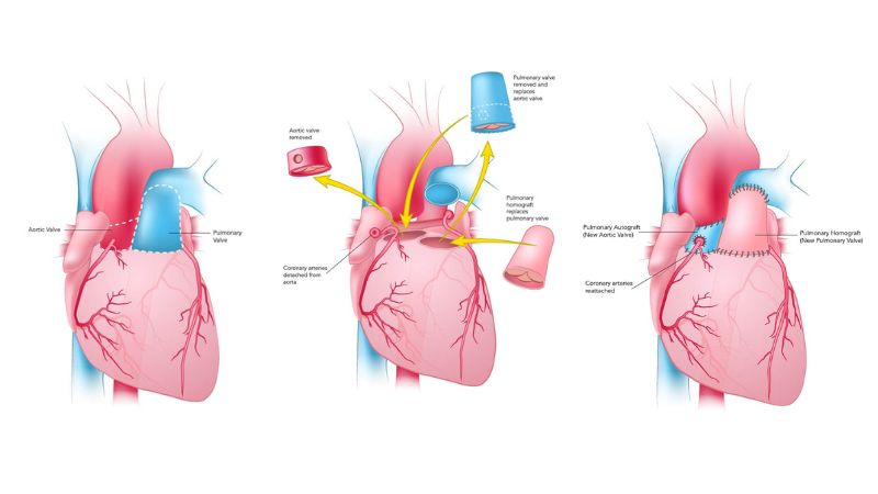 ross procedure