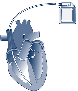 single chamber pacemaker