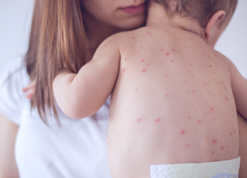 baby with measles