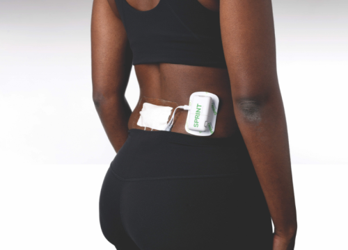 woman receiving Sprint PNS treatment on her back