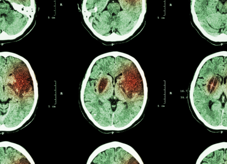 Stroke Care