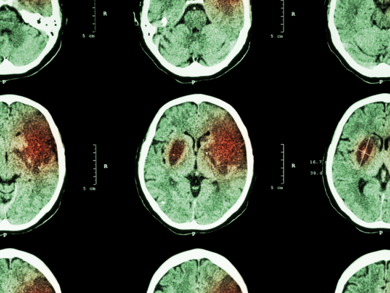 The Valley Hospital Stroke Center: advanced care at a second’s notice