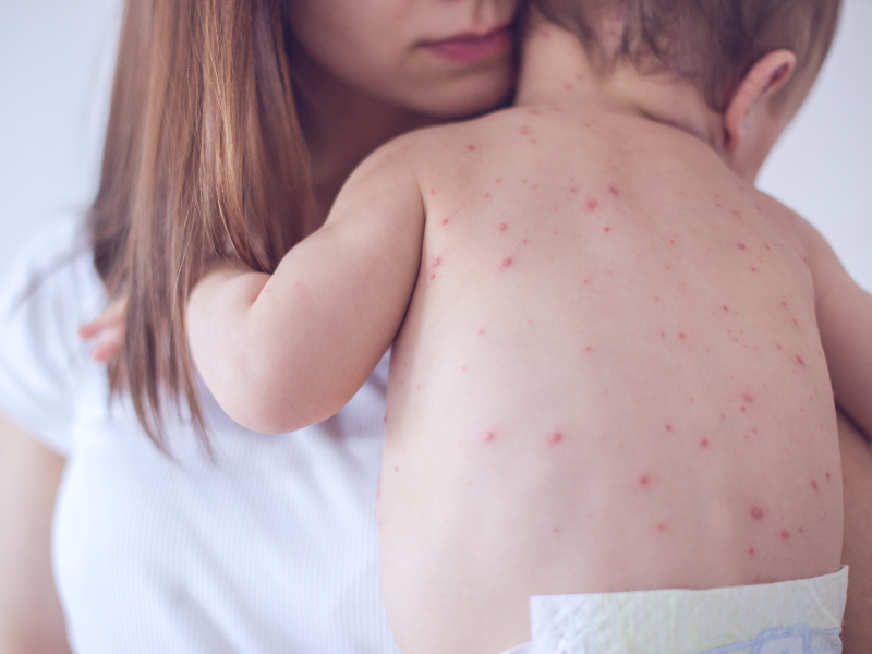 baby with measles