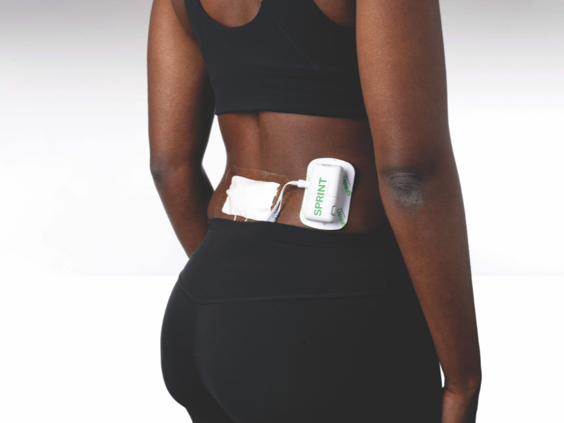 woman receiving Sprint PNS treatment on her back